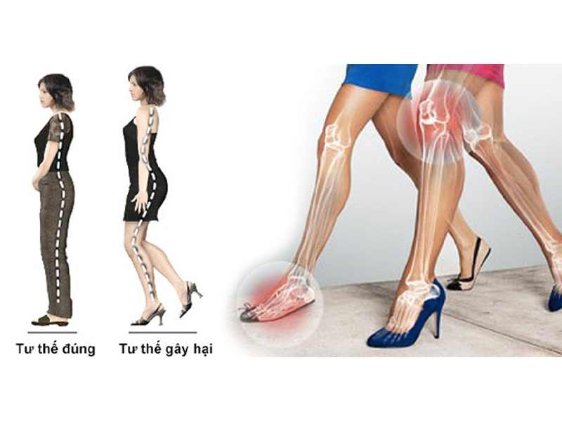 phong-va-chua-dau-moi-chan-khi-deo-giay-cao-got-thuong-xuyen